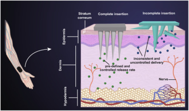 The advantages of microneedle patches compared to conventional needle-based drug delivery and biopsy 